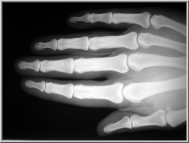 Gothard Jenő jobb kezének röntgenképe
